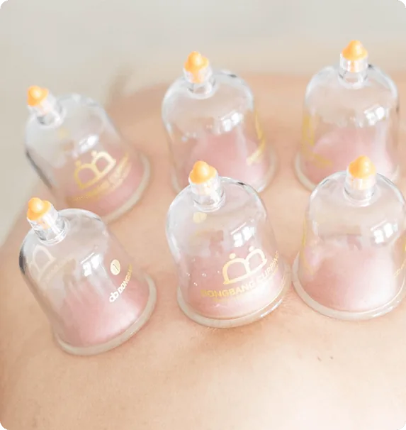 Cupping therapy Toronto Spa