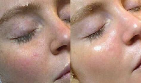 Showing results of HydraFacial in Toronto with boosters