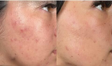 HydraFacial treatment at Pamper Valley spa in downtown Toronto