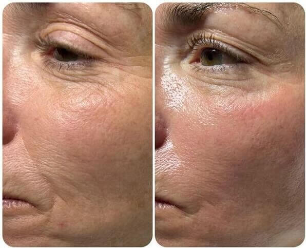 HydraFacial treatment at Pamper Valley spa in downtown Toronto