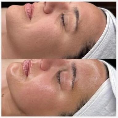 HydraFacial treatment at Pamper Valley spa in downtown Toronto
