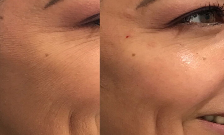 Showing results of Toronto HydraFacial with boosters